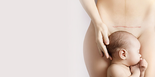 Childbirth - Post natal - caesarean operation